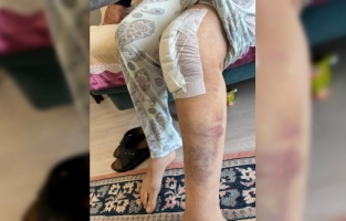 Kahramanmaraş'ta doğuştan diz rahatsızlığı yaşayan genç sağlığına kavuştu